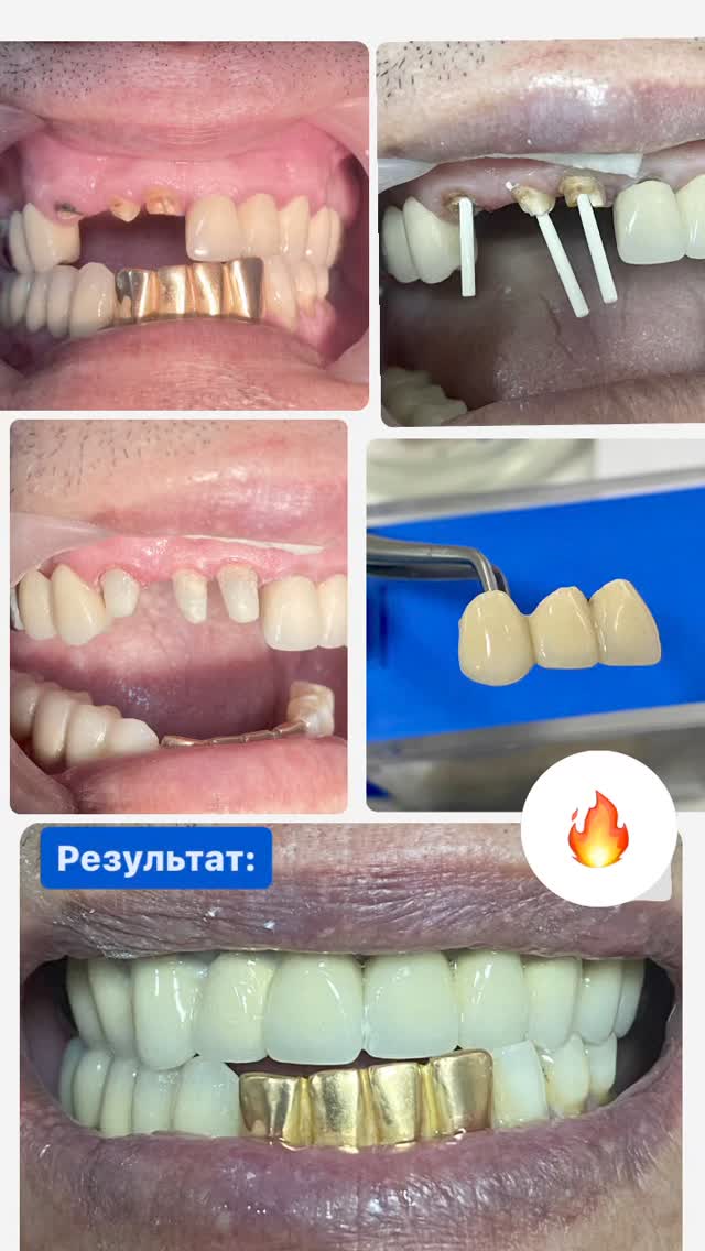 Ортопедия — коронки