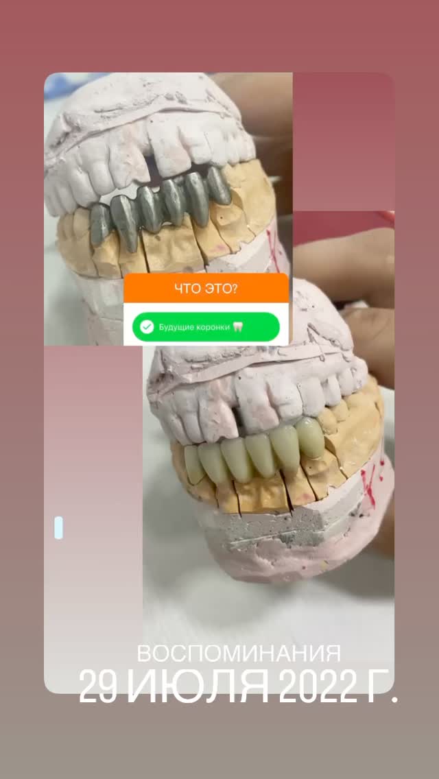 Протезирование