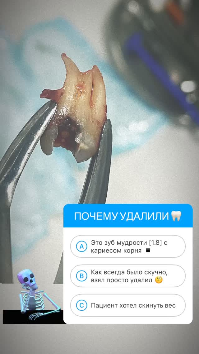 Удаление зубов