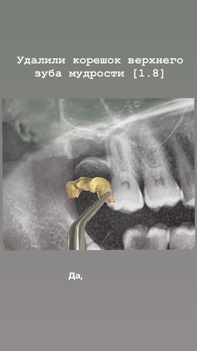 Удаление зубов