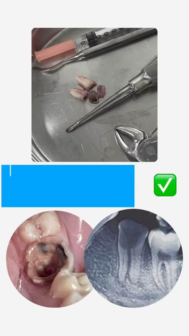 Удаление зубов