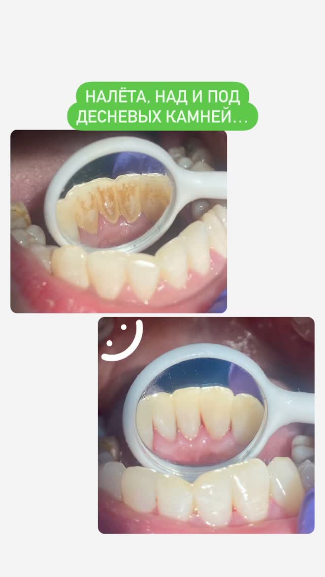 Проф.Чистка