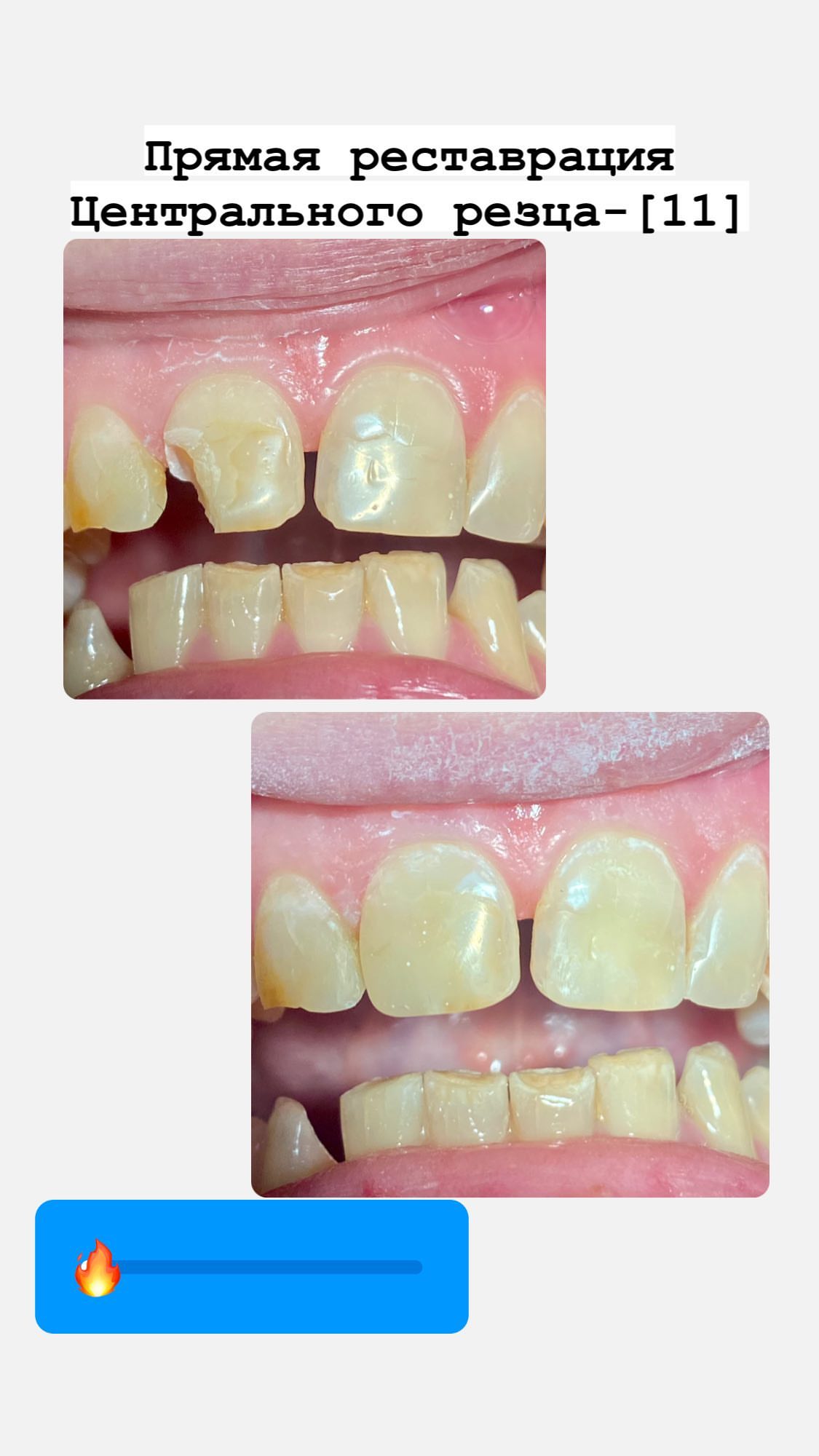 Лечение кариеса