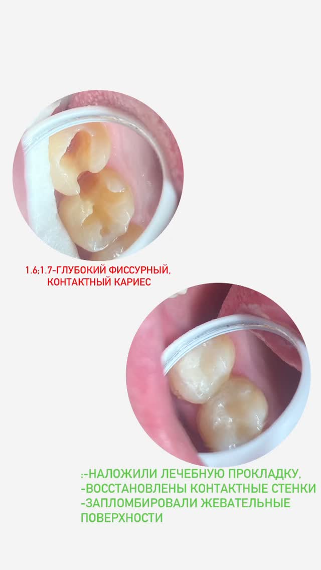 Лечение кариеса