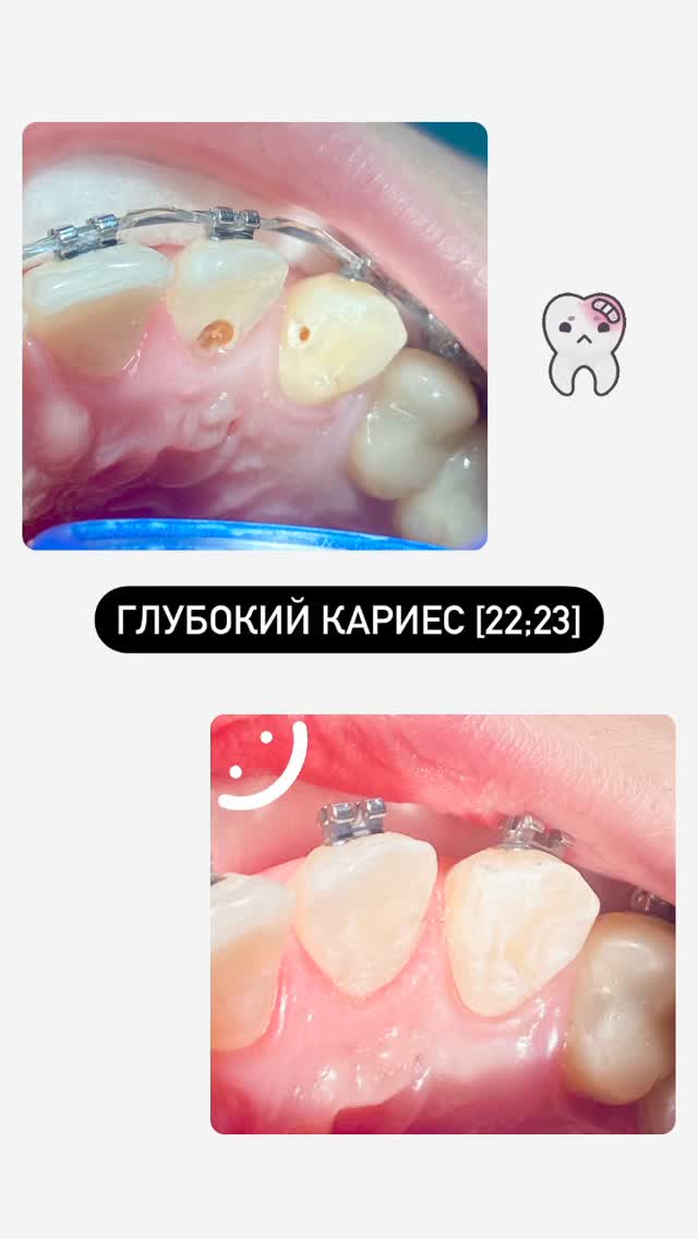 Кариес