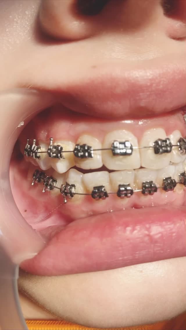 Брекеты