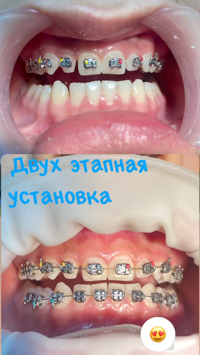 Установка брекетов