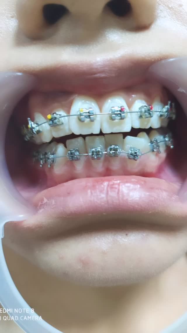 Брекеты